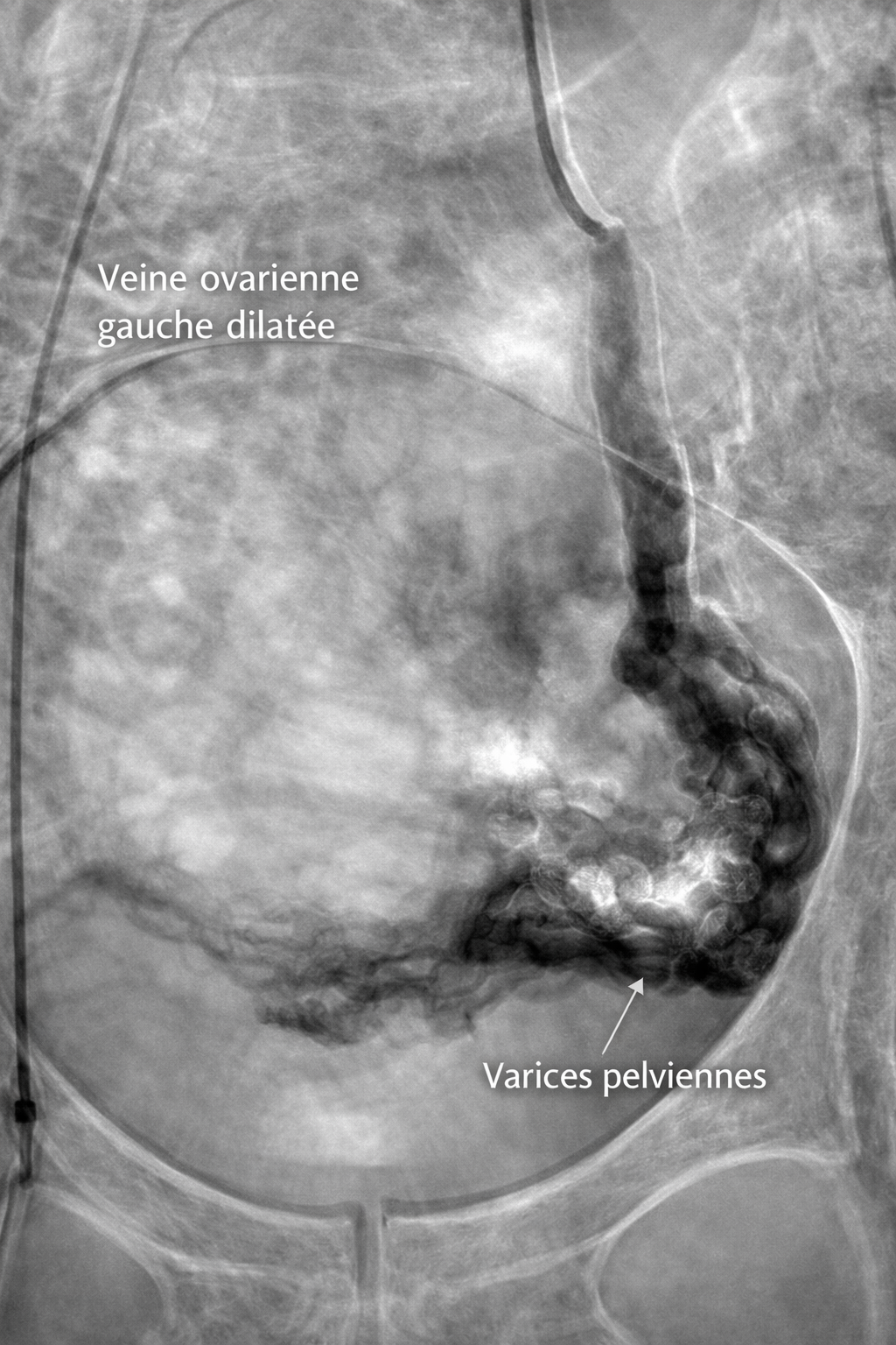 varices pelv image améliorée